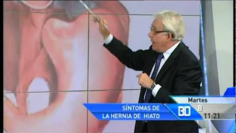 ¿Puede el estrés agravar la hernia de hiato?