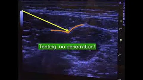Quadratus lumborum block intramuscular approach for pediatric surgery