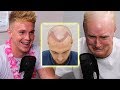 Exposing Theo's Hair Transplant Secrets