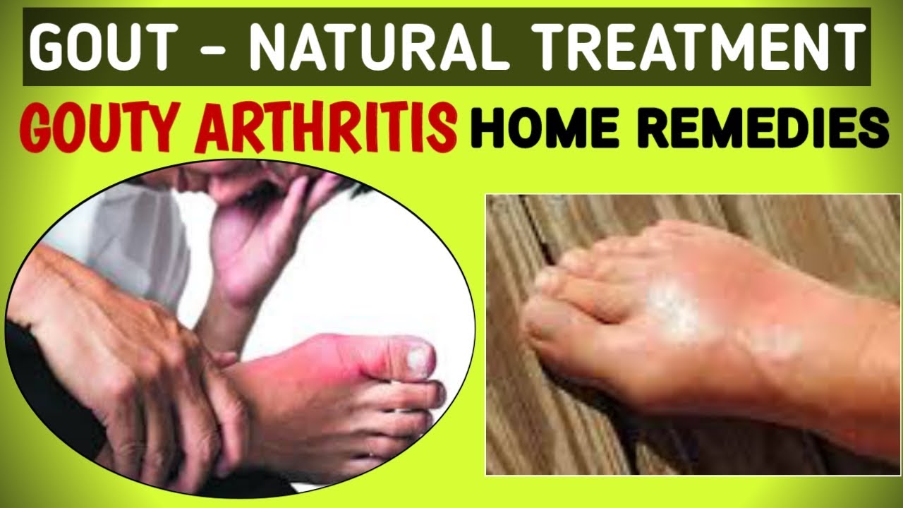 Natural Treatment For Acute Gout Gouty Arthritis Gout Home Remedies