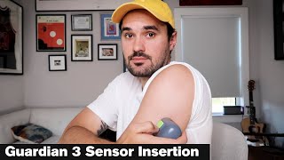 Medtronic Diabetes Guardian Sensor 3 Insertion - How to insert the Guardian 3 Sensor