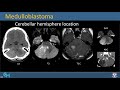 imaging of Pediatric brain tumor