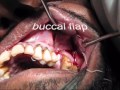 oroantral fistula closure with buccal advancement flap