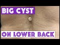 OMG!! She’s had this weird lump on her back for years, but when the doctor cuts into it