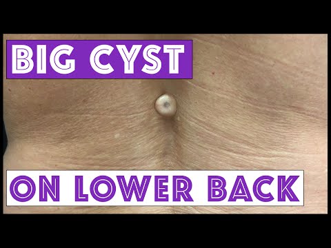 BIG Cyst On Lower Back!