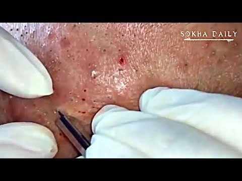 Acne Treatment Blackheads Removal on Forehead#