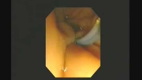 ERCP - Sphincterotomy and stone extraction - STEFANOS DOKAS - The ERCP Channel