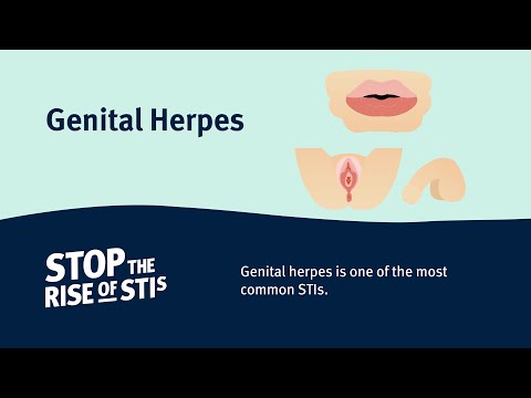 Vídeo: Herpes Anal: Síntomas, Tratamiento, Diagnóstico Y Más