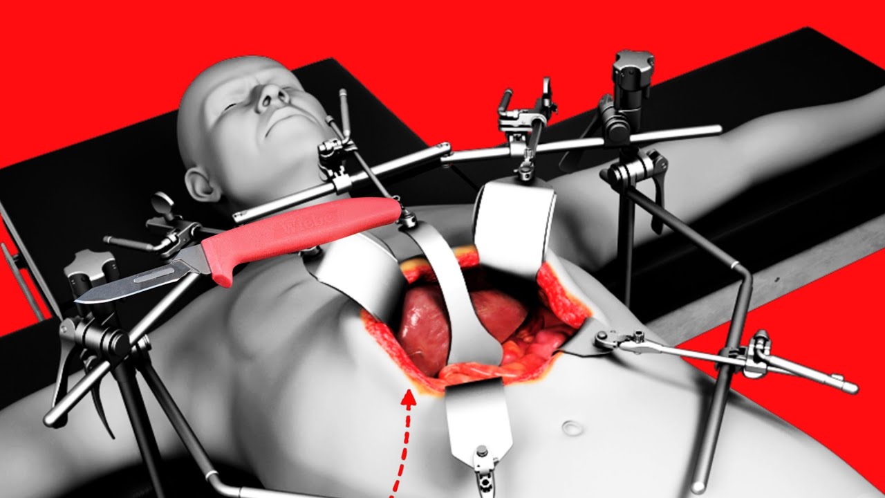 Valve Replacement Surgery  3D Animation   Open Procedure