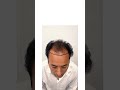 Mega Hair Transplant Success: A Casual Look at a Serious Transformation!