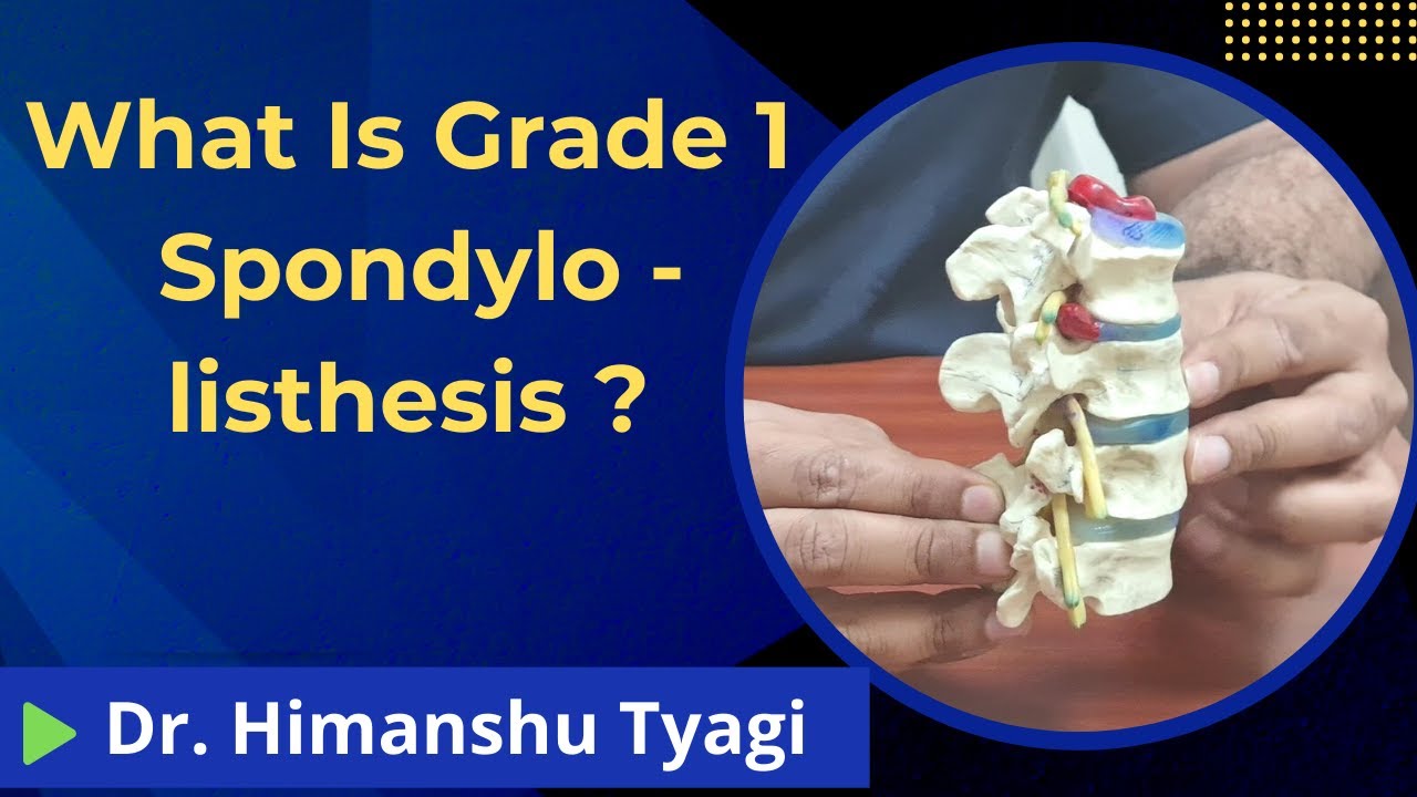 What Is Grade 1 Spondylolisthesis YouTube