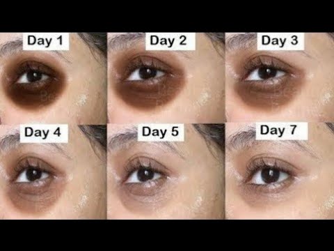 How to Use an Ice Cube to Cure Puffy Under Eyes