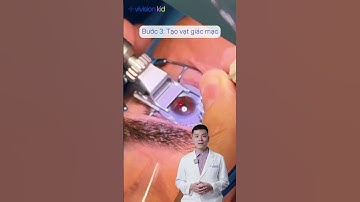Mổ cận bằng LASIK: 5 bước phẫu thuật mà bạn sẽ trải qua! #lasikeyesurgeon #canthi #mocan