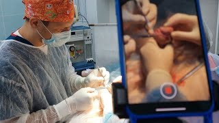 Операция циркумцизио (обрезание крайней плоти). Физиологический фимоз #циркумцизия #фимоз #обрезание