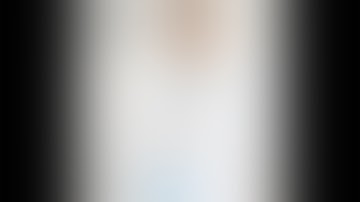 Uniportal VATS S6 Segmentectomy for A-V Malformation