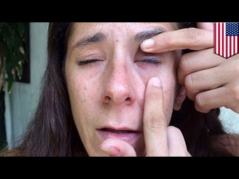 Женщина случайно заклеила себе глаз суперклеем