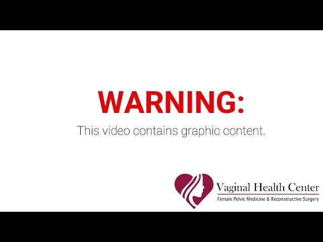 Vaginal Tightening, Bladder & Rectocele Procedure