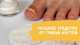 Мощное средство от грибка ногтей // Всего за 50 рублей