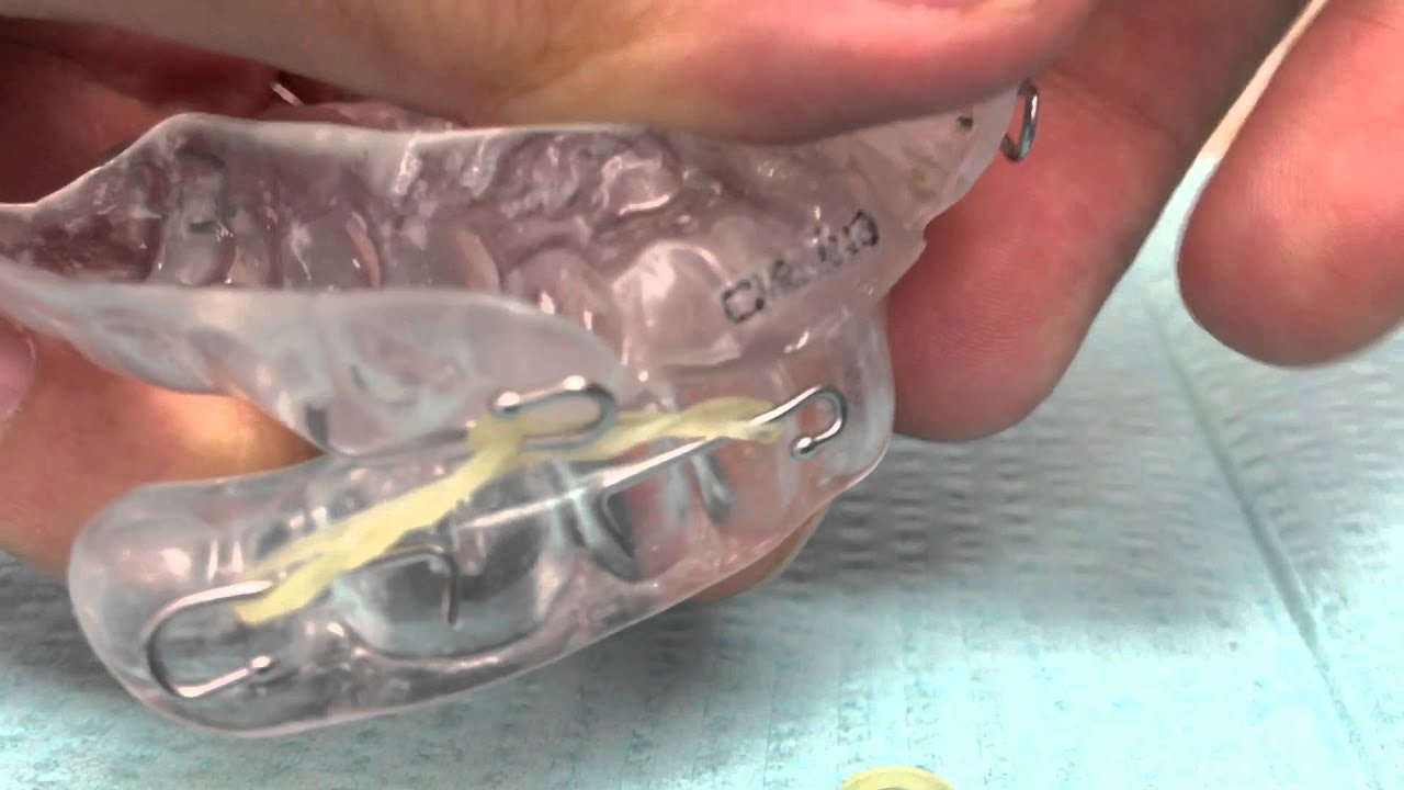 How to place rubber bands on your sleep apnea appliance. YouTube