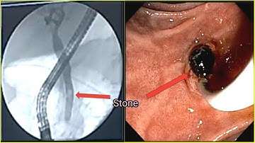 ERCP Stone Extraction #BD_ENDOSCOPY