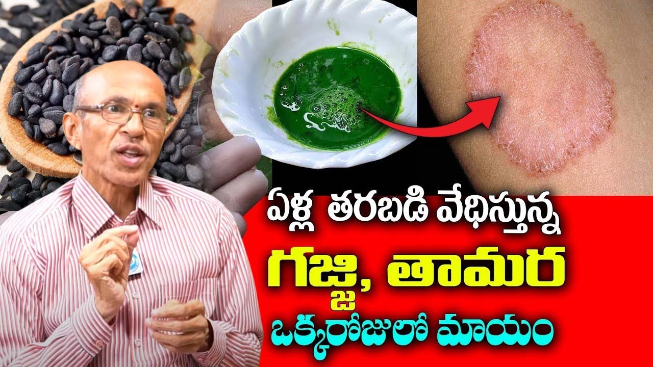 Madhusudana Sharma | ఒక్క రోజులో తామర మటుమాయం || How to Remove Ringworm Naturally | iDream Health