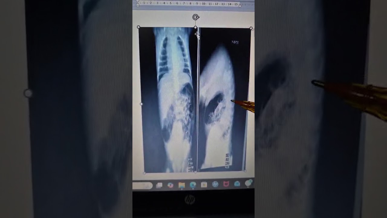 ano imperforado Dina Alejandra Rangel Char 25001518