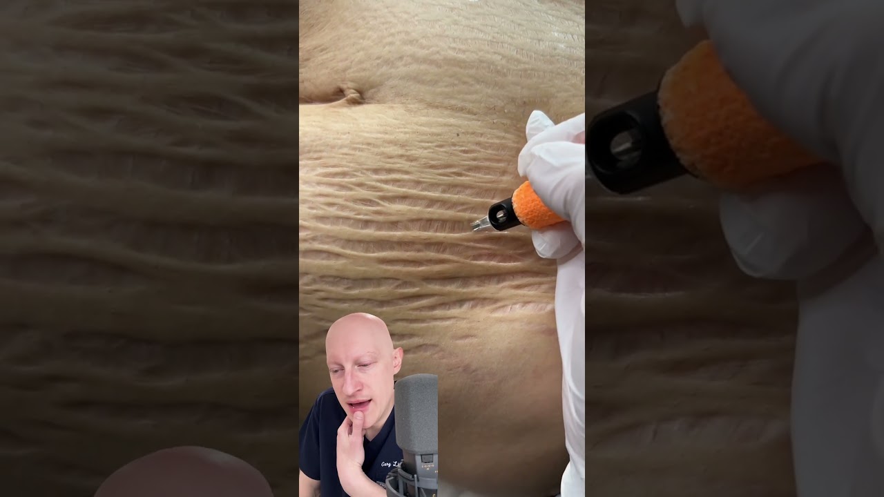 Plasma Pen As A Cure For Stretchmarks? | Doctor Reacts