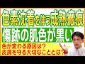 黒くなってしまった傷跡は治せる？(色素沈着を伴う成熟瘢痕) 形成外科きずときずあとのクリニックでの治療内容を院長が解説！【皮膚を守る大切な事とは？】