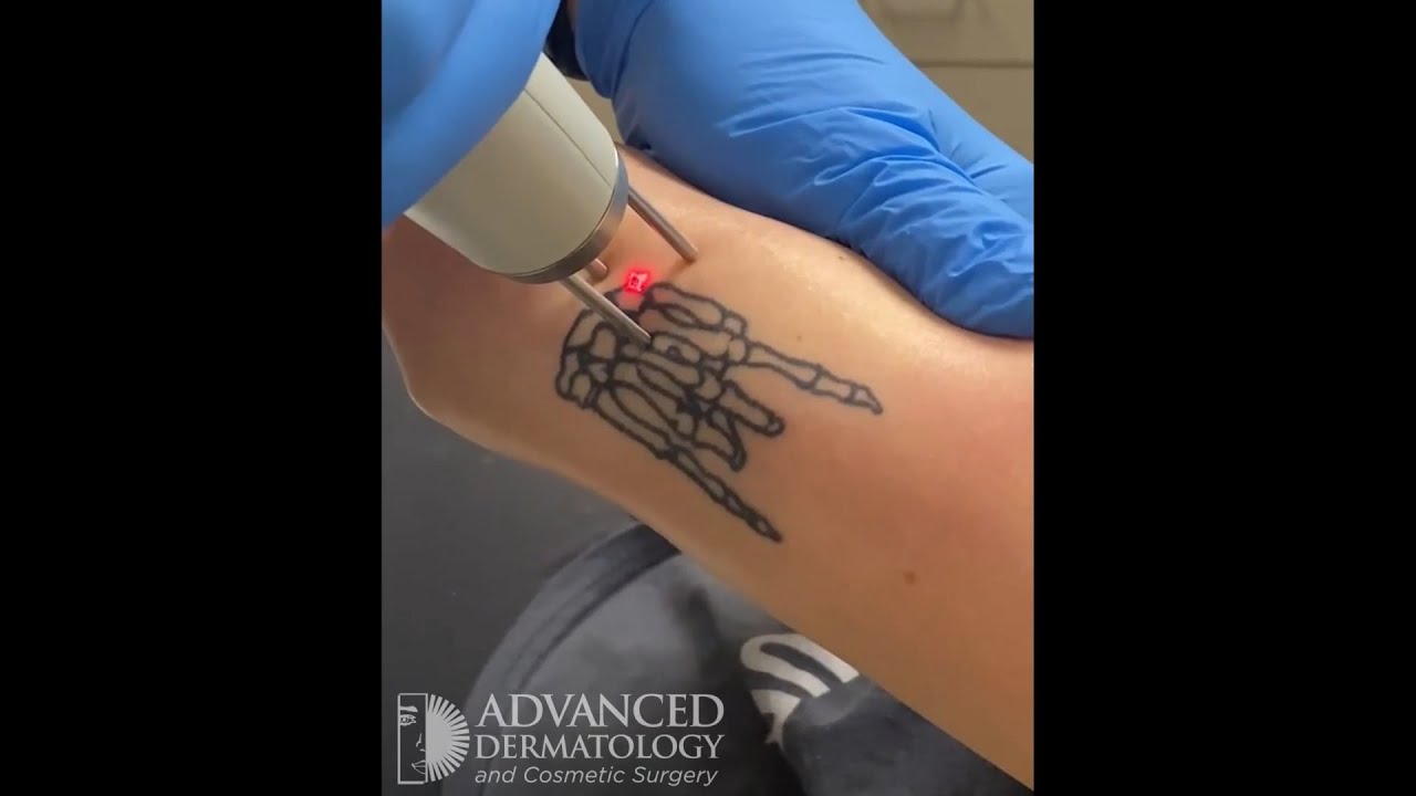 fyp #tattoo #tatt ##tattoos #ink #dermatologist #dermdoctor #immunolo... |  TikTok