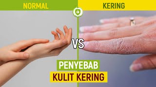 KULIT KERING! INI PENYEBAB YANG HARUS DIKETAHUI - Info Sehat