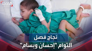 نجاح فصل التوأم السيامي السوري إحسان وبسام في الرياض