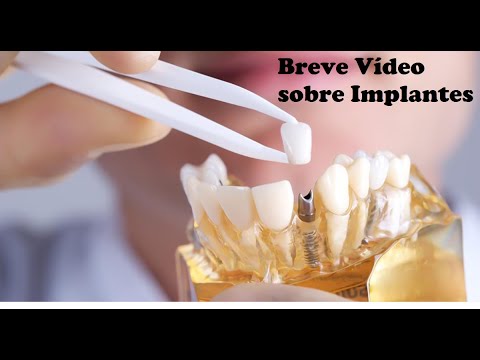 Vídeo: como funciona o implante dentário — Dr. Luís Morato