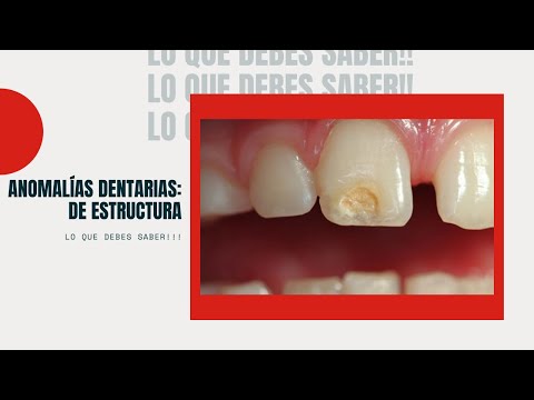Vídeo: Hipoplasia Dental: Tratamiento, Causas, Fotos, Formas