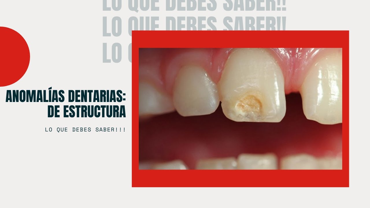 Anomalía Dentaria:De estructura (Hipoplasia del Esmalte, Amelogénesis Imperfecta, etc).