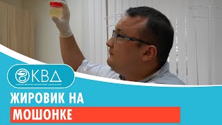 Жировик на мошонке Клинический случай 75