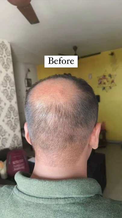 Shocking hair growth results of Keshpallav Hair Oil #haircare #hairfall #shorts 🌿✨️
