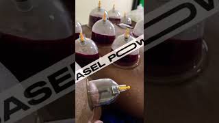 therp chiropractic therapy chiropractor cupping massage