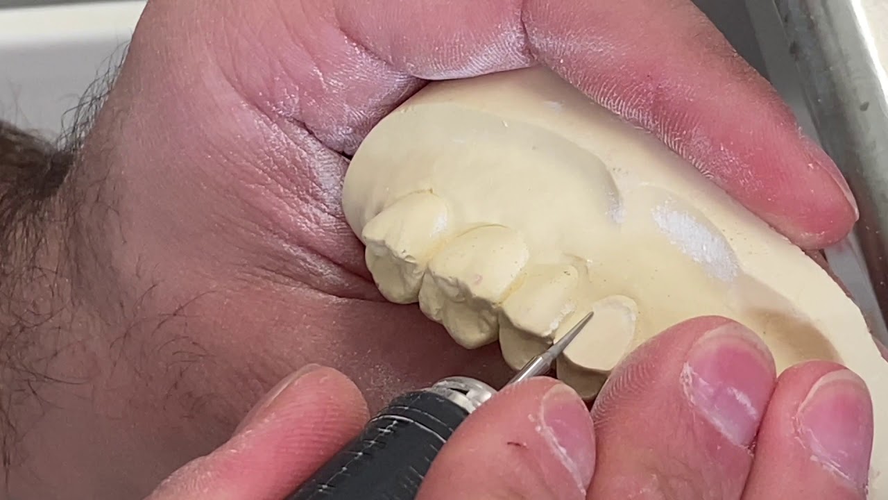 limatura moncone premolare superiore