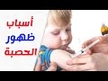 اسباب ظهور مرض الحصبة وكيفية الوقاية منه
