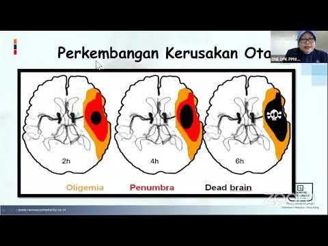 Video: Percobaan Terkontrol Secara Acak Dari Terapi Antiplatelet Dalam Kombinasi Dengan Trombolisis Rt-PA Pada Stroke Iskemik: Dasar Pemikiran Dan Desain ARTIS-Trial