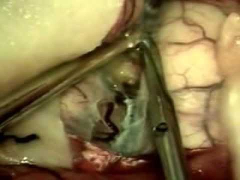 opening sylvian fissure no1. by Prof. Aadil S Chagla