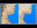 Neck Lift Jawline Liposuction For Younger People - Beverly Hills