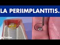 Periimplantitis ©