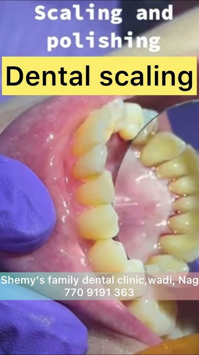 live-how-to-get-teeth-cleaned-dental-scaling-or-cleaning-procedure