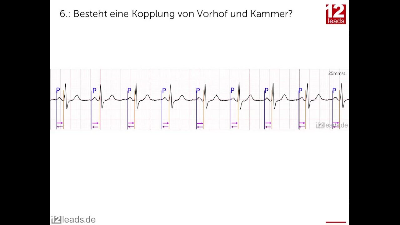 1 Ist Eine Geordnete Kammeraktivitat Vorhanden Herzkurven