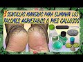 Callos que Desaparecen Tratamiento Casero-3 Sencillas Maneras para Eliminar los Pies Callosos