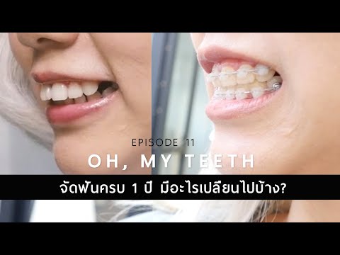 #Ohmyteeth EP.11 จัดฟันครบ 1 ปี มีอะไรเปลี่ยนแปลงบ้าง!!!!! เปลี่ยนไปเยอะอยู่นะ 555 . Ploy Sapphires