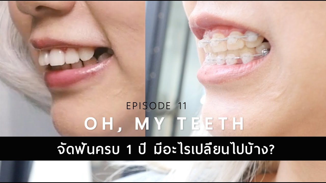 #Ohmyteeth EP.11 จัดฟันครบ 1 ปี มีอะไรเปลี่ยนแปลงบ้าง!!!!! เปลี่ยนไปเยอะอยู่นะ 555 . Ploy Sapphires