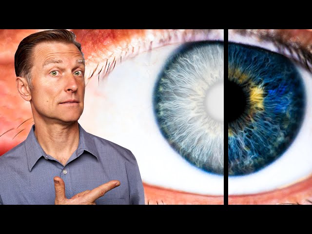 This Vitamin Reverses GLAUCOMA?!