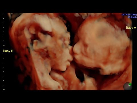 Mom-To-Be Shocked When Her Twins Were Caught Kissing On Sonogram